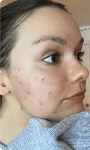 Before - No Acne Anymore!