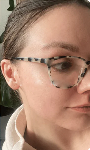 After - No Acne Anymore!